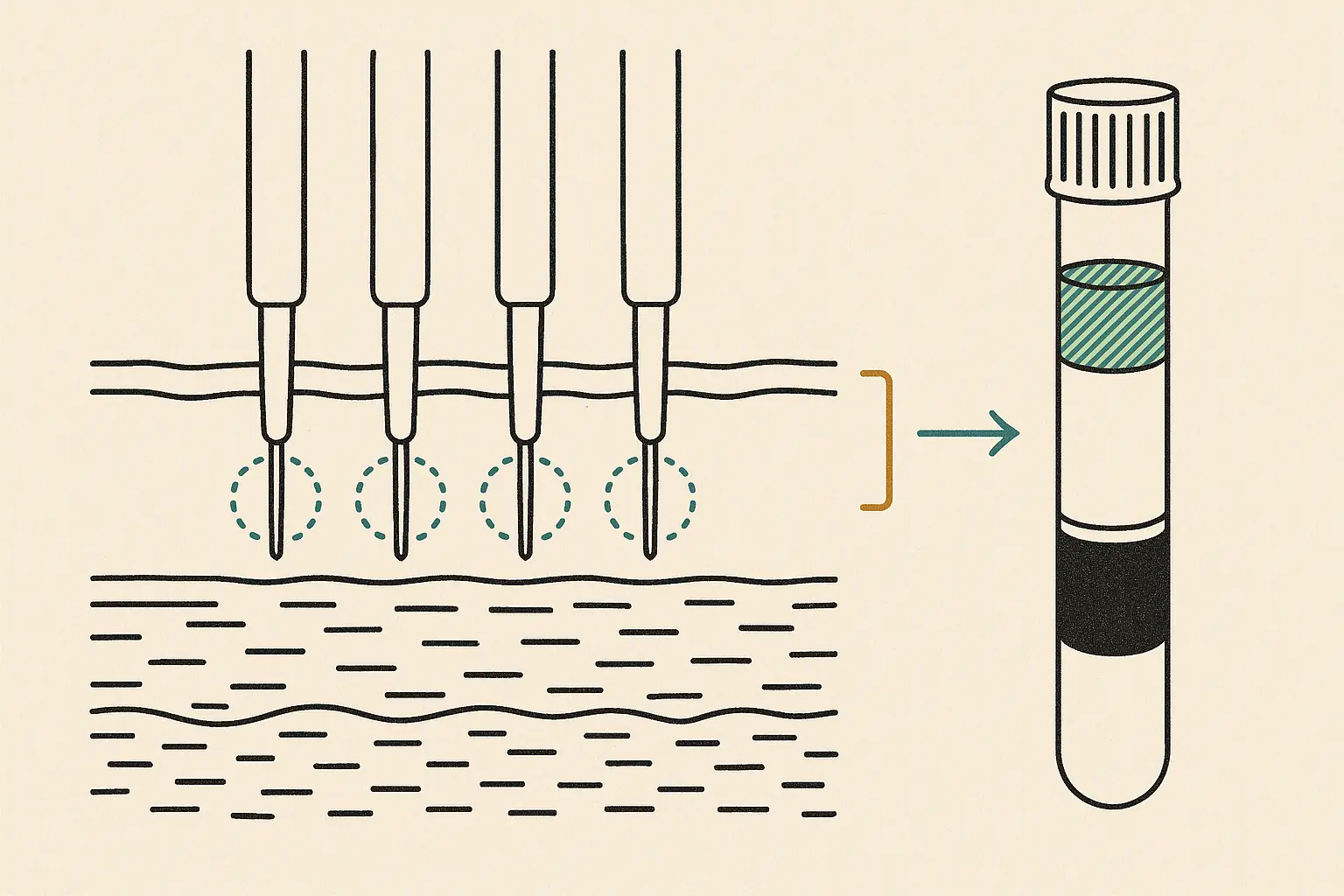 Duotone patent-figure-style line drawing: four insulated microneedles pierce a layered skin cross-section, with dashed teal circles marking the thermal zones at the exposed needle tips and an amber bracket marking their depth; beside it, a centrifuged blood tube shows separated layers with the platelet-rich plasma band hatched in teal. No faces, text, or brand marks appear.